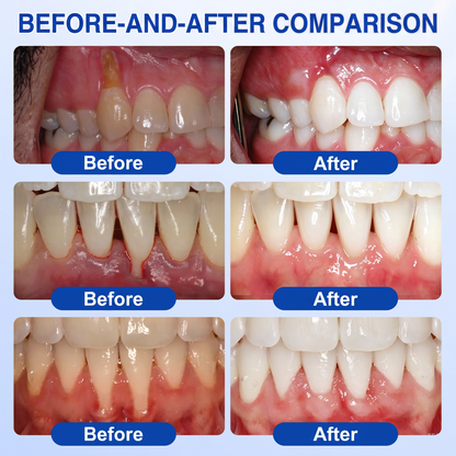 Glimmerly® 🦷GumRevive periodontal repair gel🌳
