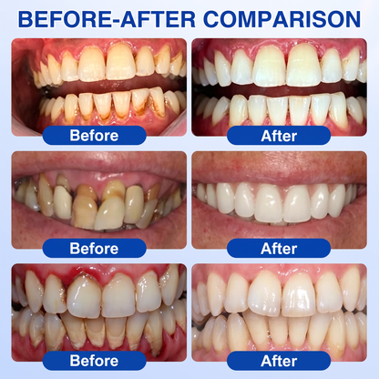 Glimmerly® 🦷GumRevive periodontal repair gel🌳