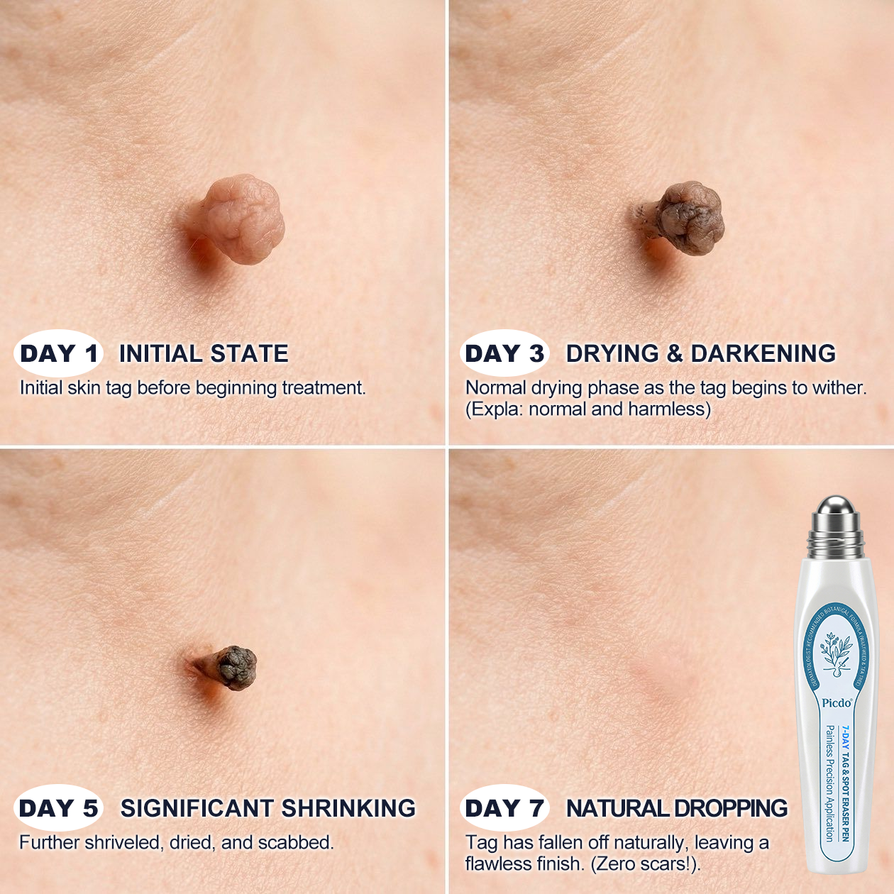 Official Store🎉𝐏i𝐜𝐝o® 7-𝐷𝑎𝑦 𝗧𝐚𝐠 & 𝗦𝗽𝐨𝐭 𝐄𝐫𝒂𝒔𝒆𝒓(Zero Pain, Zero 𝐒𝐜𝐚𝒓𝒔 Rollerball)