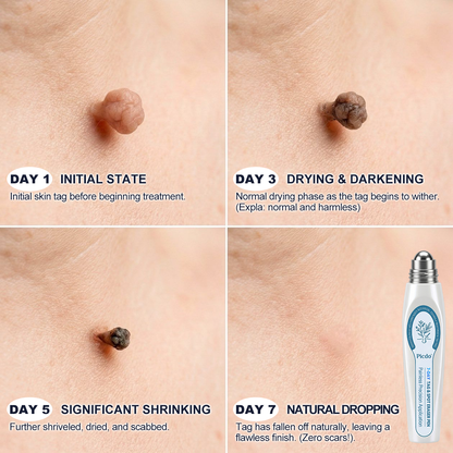 Official Store🎉𝐏i𝐜𝐝o® 7-𝐷𝑎𝑦 𝗧𝐚𝐠 & 𝗦𝗽𝐨𝐭 𝐄𝐫𝒂𝒔𝒆𝒓(Zero Pain, Zero 𝐒𝐜𝐚𝒓𝒔 Rollerball)
